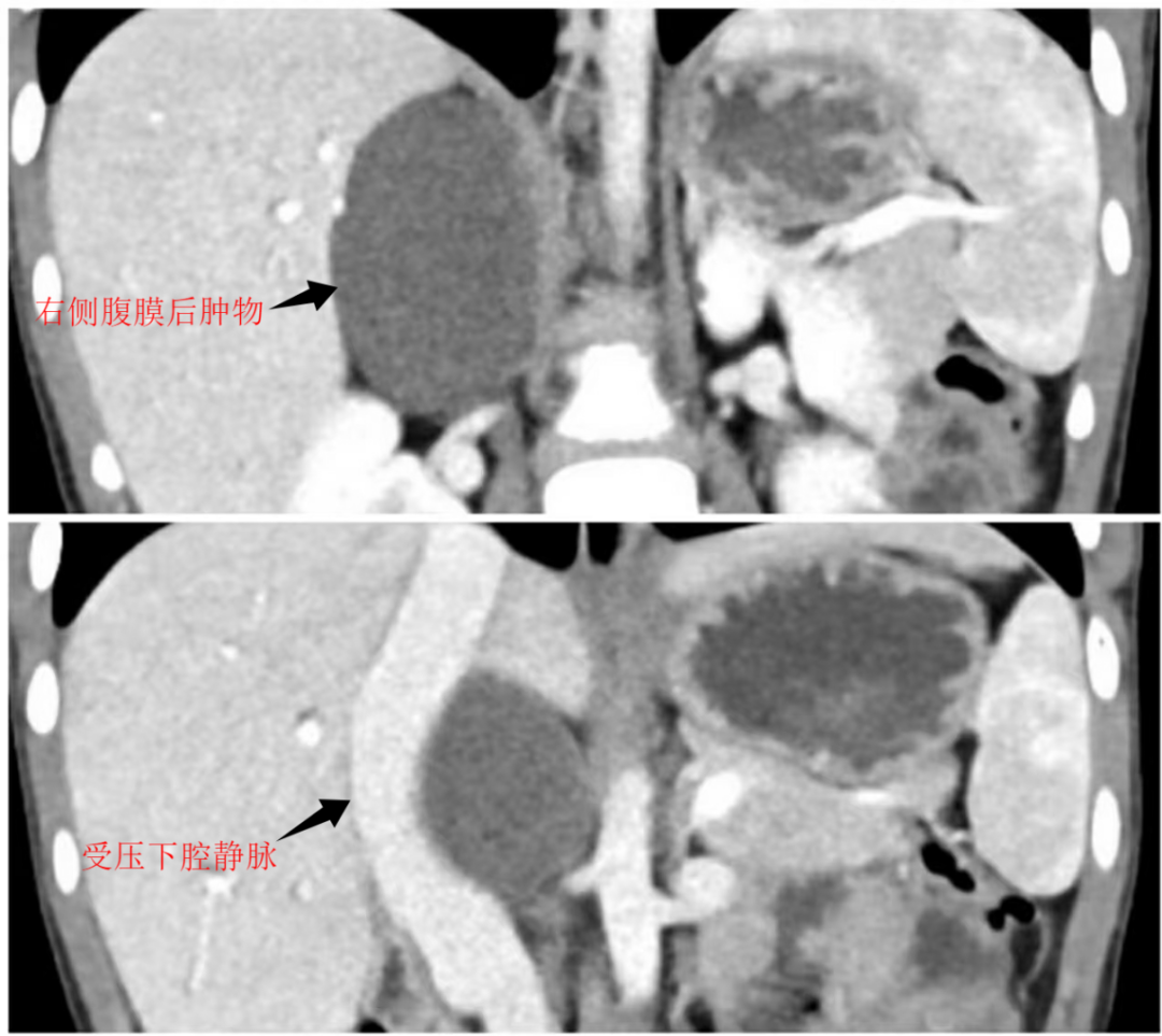 交医精术 | 小儿外科成功为 9 岁女童实施高难度单孔腹腔镜腹膜后巨大肿物切除术
