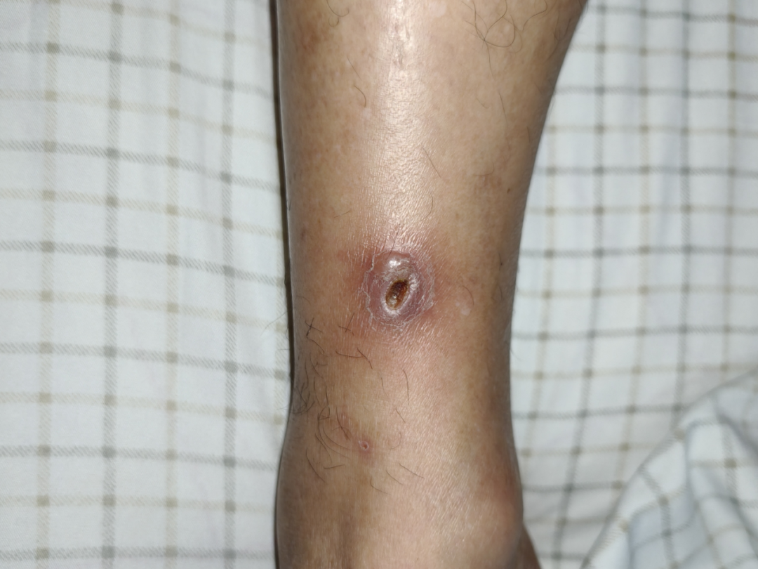 不及时处理致死率近 100%！这种「小伤」不能大意