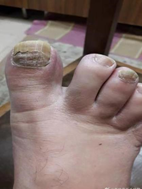 护理科普 | 造血干细胞移植后指甲的护理