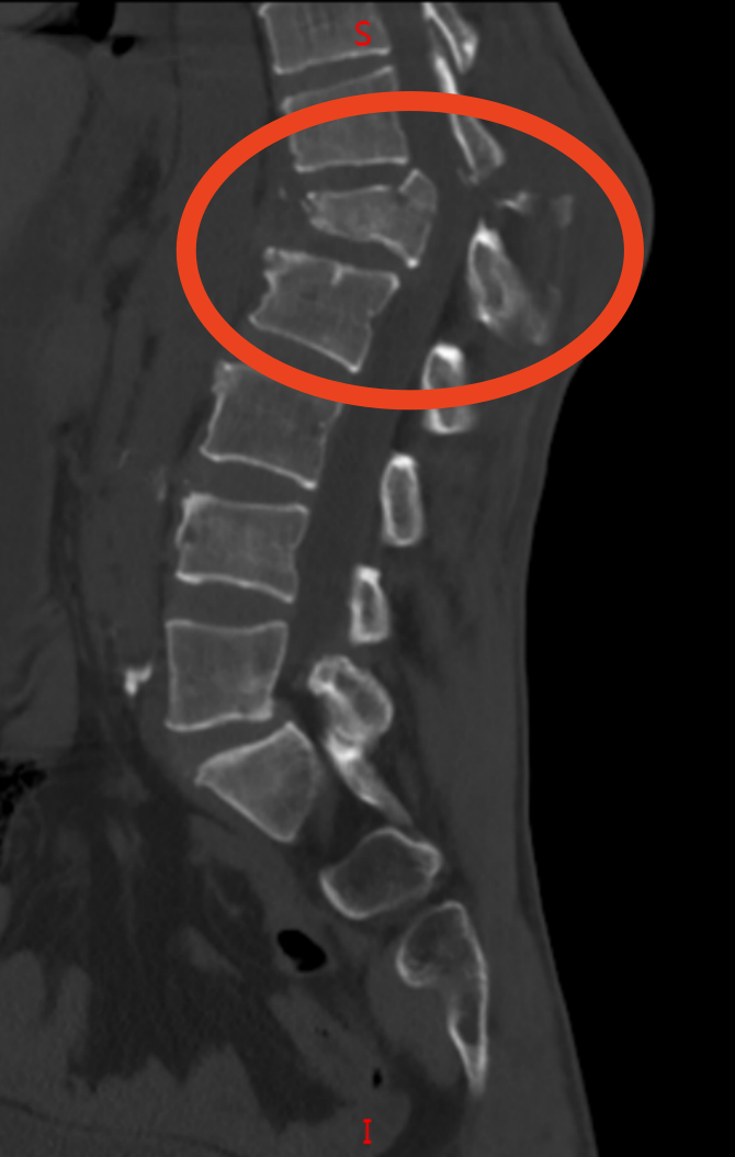 脊柱外科技术巡展：用技术与温情筑牢 「人体支柱」 的健康防线