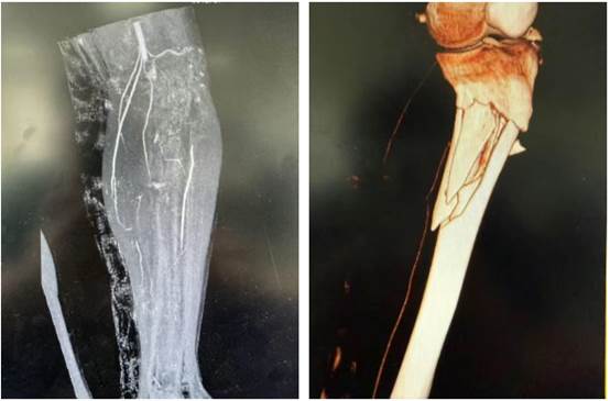 跨越 300 公里生命接力！北疆区域医疗中心 6 小时「抢通」血管 保肢成功