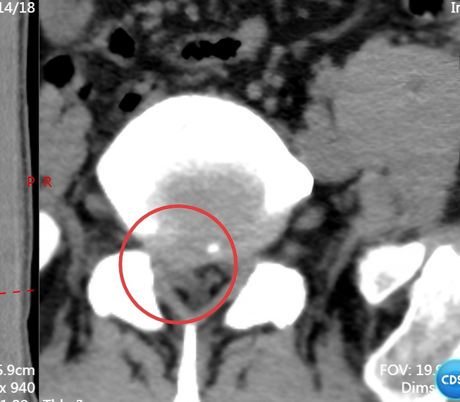 脊柱外科技术巡展：用技术与温情筑牢 「人体支柱」 的健康防线