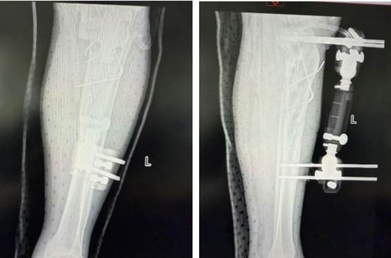 跨越 300 公里生命接力！北疆区域医疗中心 6 小时「抢通」血管 保肢成功