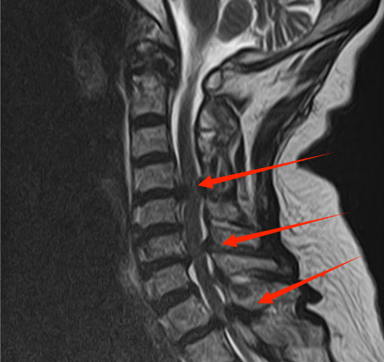 搭乘「空中 120」转运、双下肢瘫痪的高龄患者康复出院