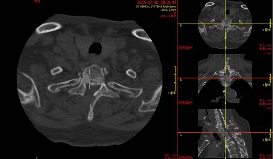 搭乘「空中 120」转运、双下肢瘫痪的高龄患者康复出院