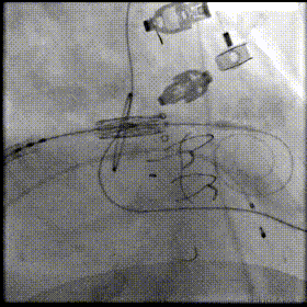 为 90 岁老人「心内绣花」介入实现「瓣中瓣」