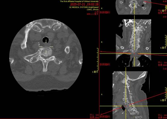 搭乘「空中 120」转运、双下肢瘫痪的高龄患者康复出院