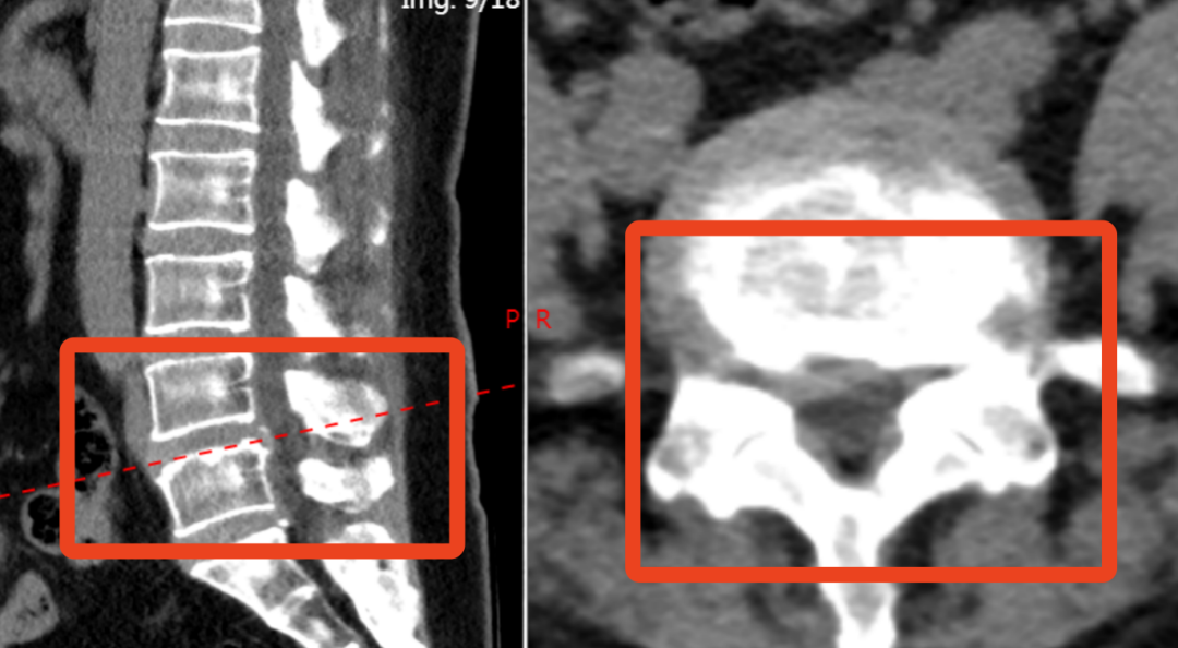 脊柱外科技术巡展：用技术与温情筑牢 「人体支柱」 的健康防线