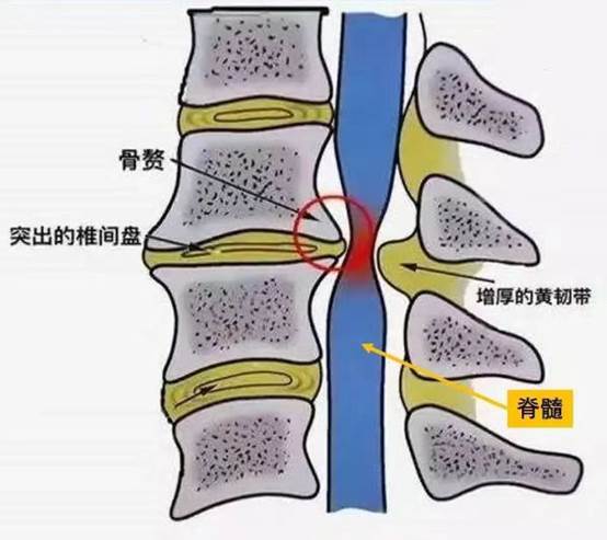 搭乘「空中 120」转运、双下肢瘫痪的高龄患者康复出院