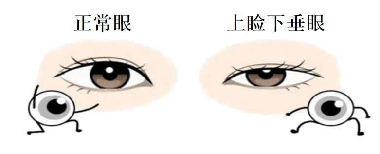 上睑下垂是一种病吗?