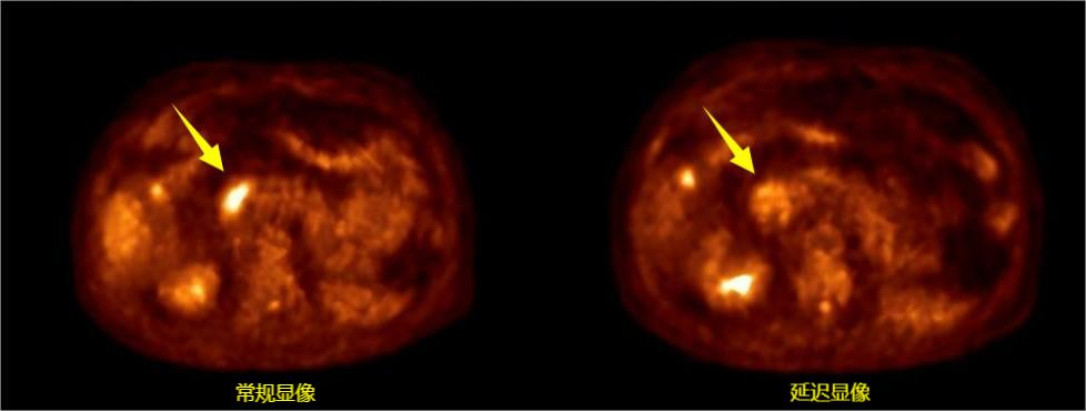 当医生说「再扫一次」:延迟显像如何让疾病无处可藏