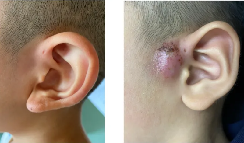 孩子身上鼓个小包,警惕这种情况,可能是癌