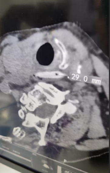 险！八旬老人枣核卡喉悬生死，阳光融和团队 30 小时生死竞速拆「弹」力挽狂澜