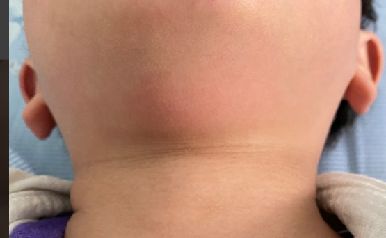 孩子身上鼓个小包,警惕这种情况,可能是癌