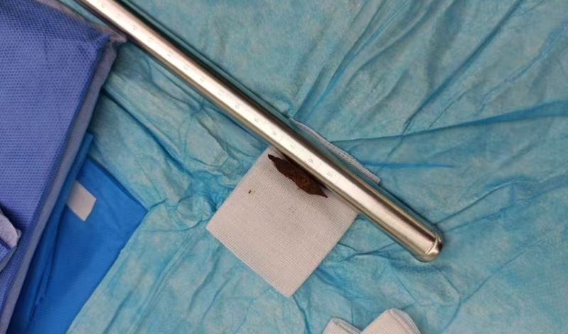 险！八旬老人枣核卡喉悬生死，阳光融和团队 30 小时生死竞速拆「弹」力挽狂澜