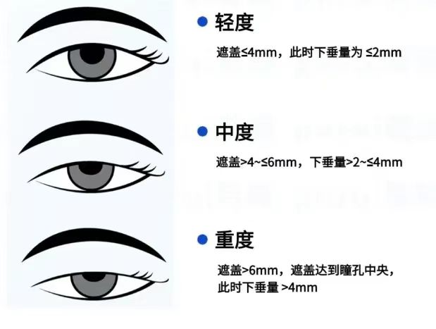 上睑下垂是一种病吗?