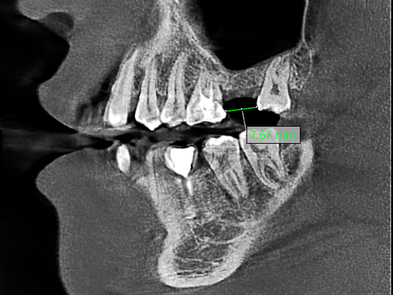 种牙怕失败？老王 4 毫米薄骨竟成功种牙，他是咋做到的