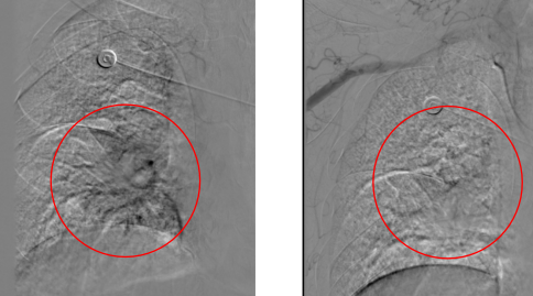 耄耋老者频繁「咯血」,子孙奔波寻医