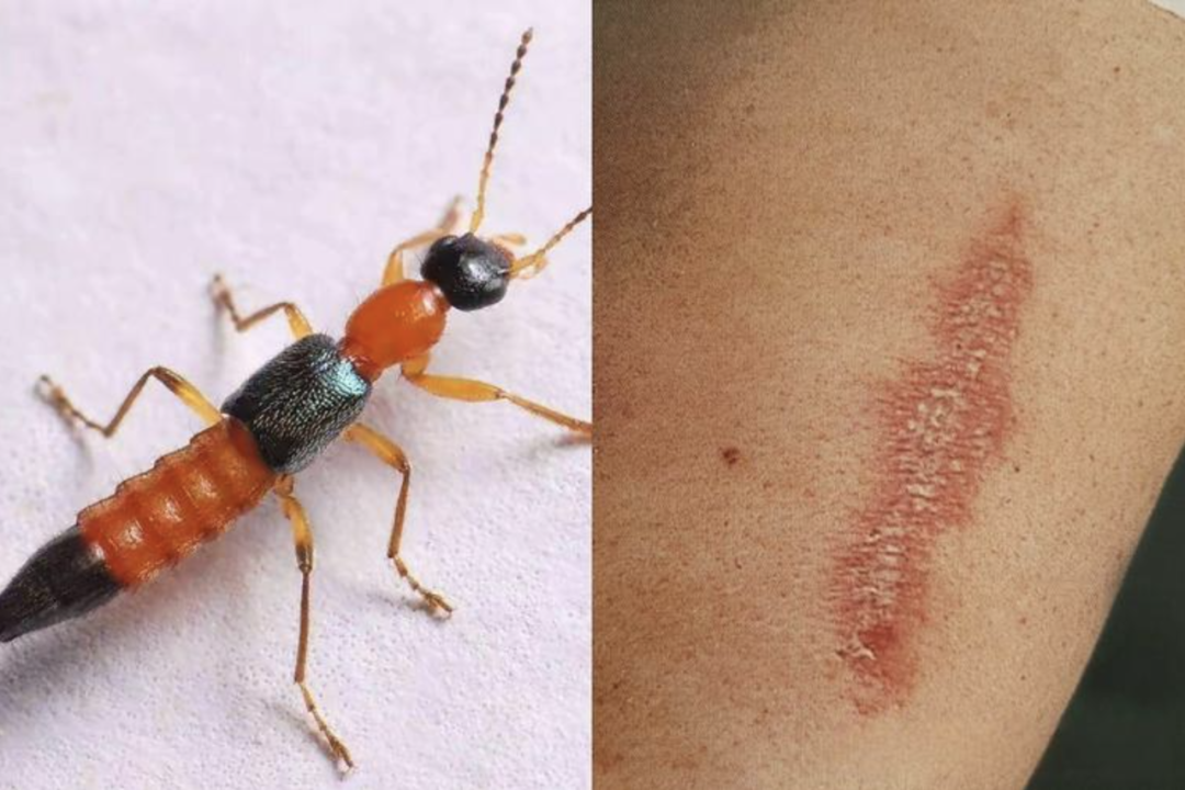 还在给虫咬处涂牙膏?错!这 4 种虫子咬后处理方式大不同