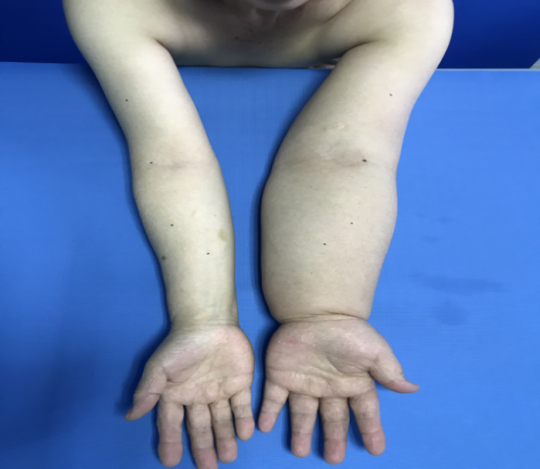 告别「大象臂」，「肿」有办法！一位淋巴水肿患者的康复之路！