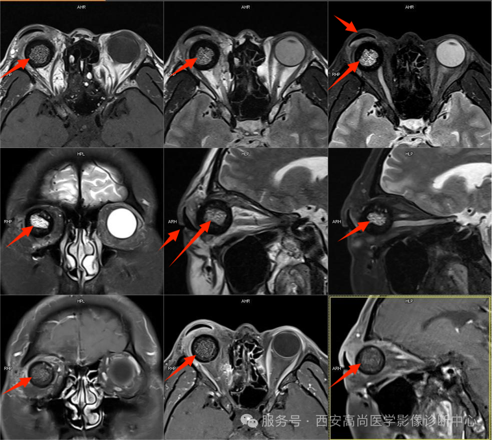 【高尚病例】眼眶 MRI 检查技术