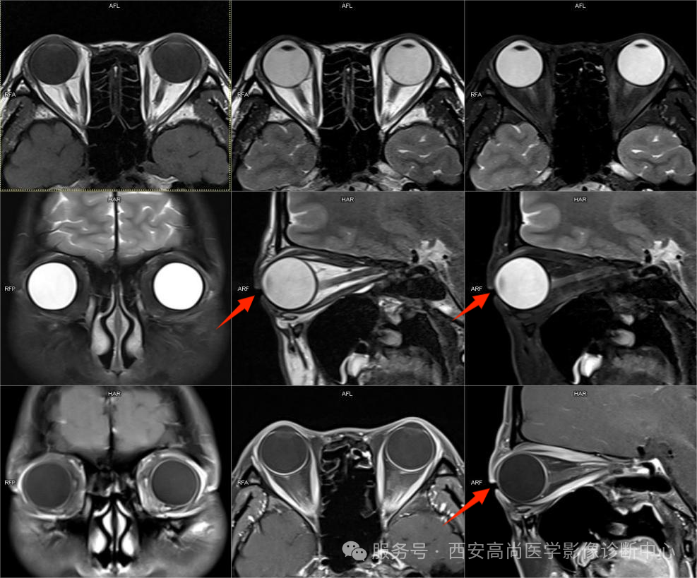 【高尚病例】眼眶 MRI 检查技术