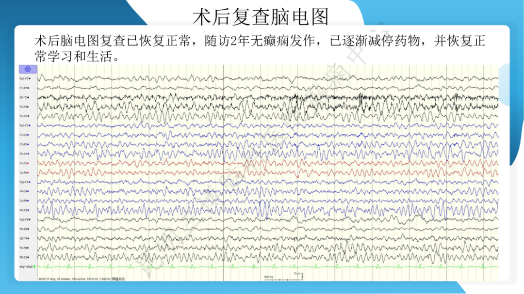 「痫停」信步》癫痫治疗病例荟萃第二十六期---SEEG 引导下射频热凝毁损治疗下丘脑错构瘤所致发笑癫痫