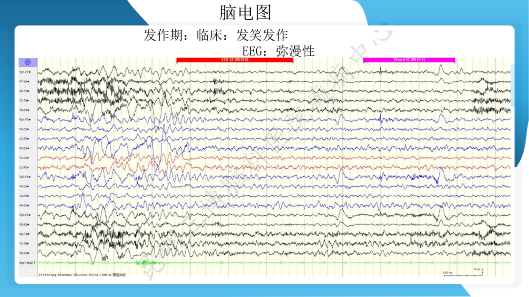 「痫停」信步》癫痫治疗病例荟萃第二十六期---SEEG 引导下射频热凝毁损治疗下丘脑错构瘤所致发笑癫痫