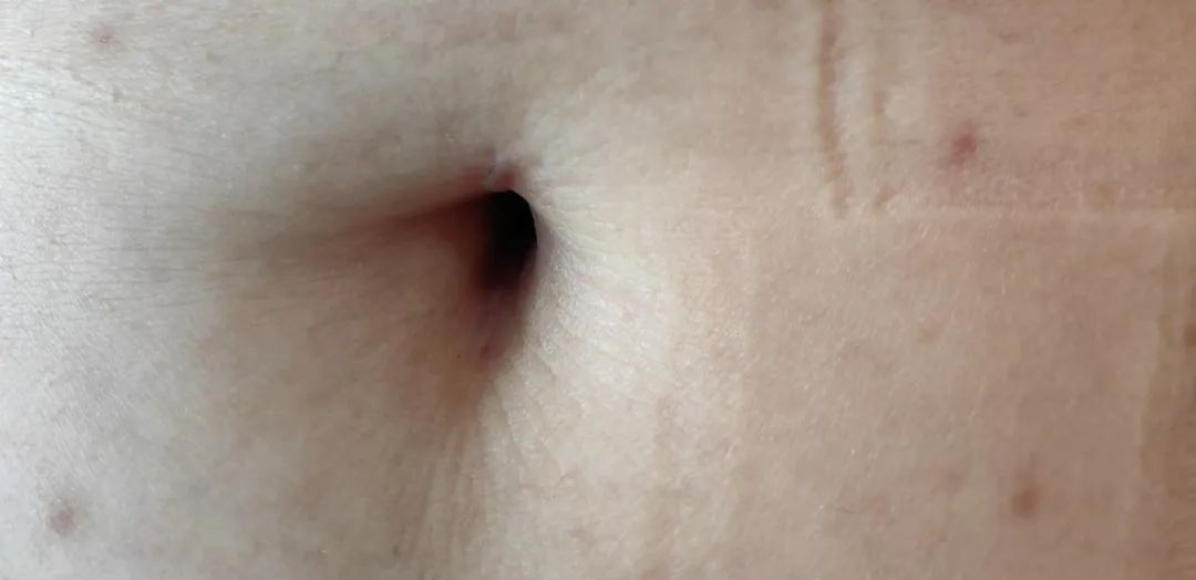 长沙江湾妇产医院技术院长周静在《妇科微型切口单孔腹腔镜手术理念与实践》上发表《微型切口单孔腹腔镜盆腔粘连松解术概述》,