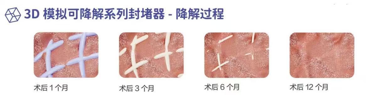 重庆松山医院成功开展生物可降解房间隔缺损封堵术