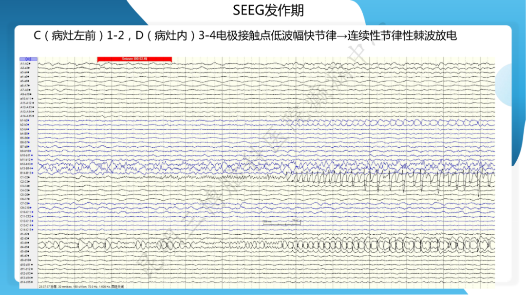 「痫停」信步》癫痫治疗病例荟萃第二十六期---SEEG 引导下射频热凝毁损治疗下丘脑错构瘤所致发笑癫痫