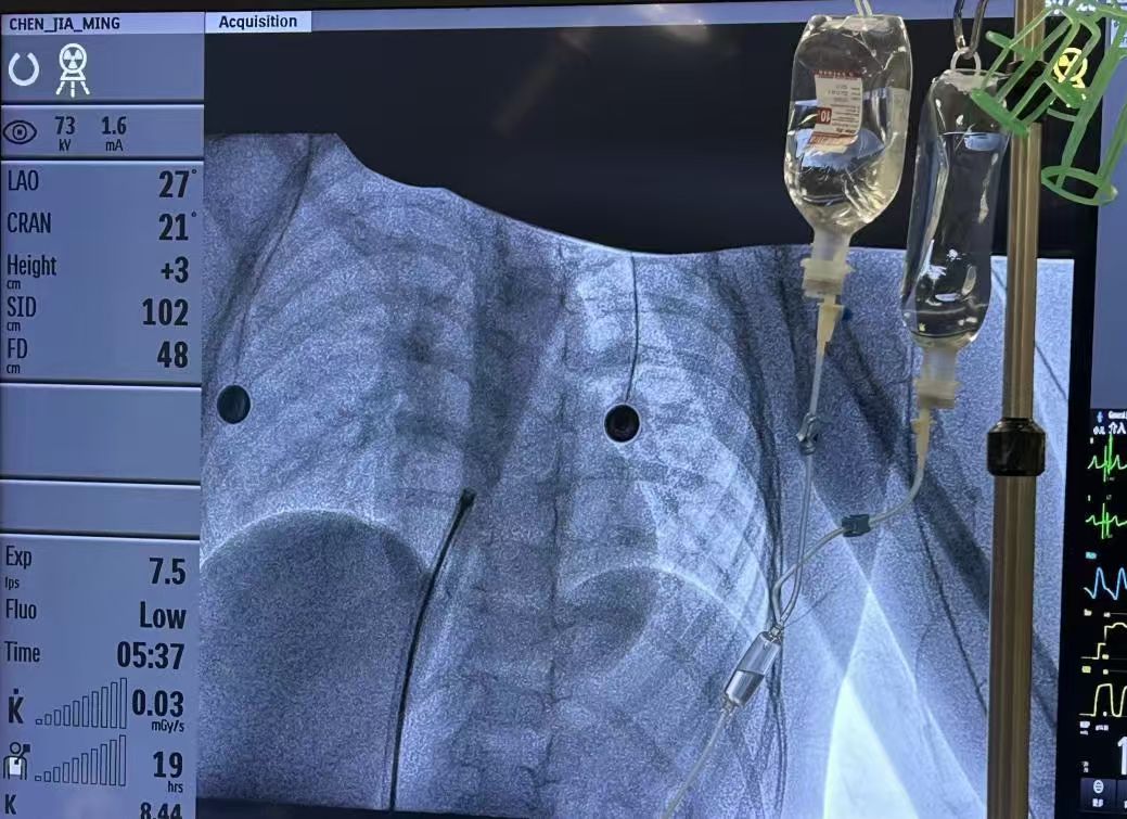 重庆松山医院成功开展生物可降解房间隔缺损封堵术