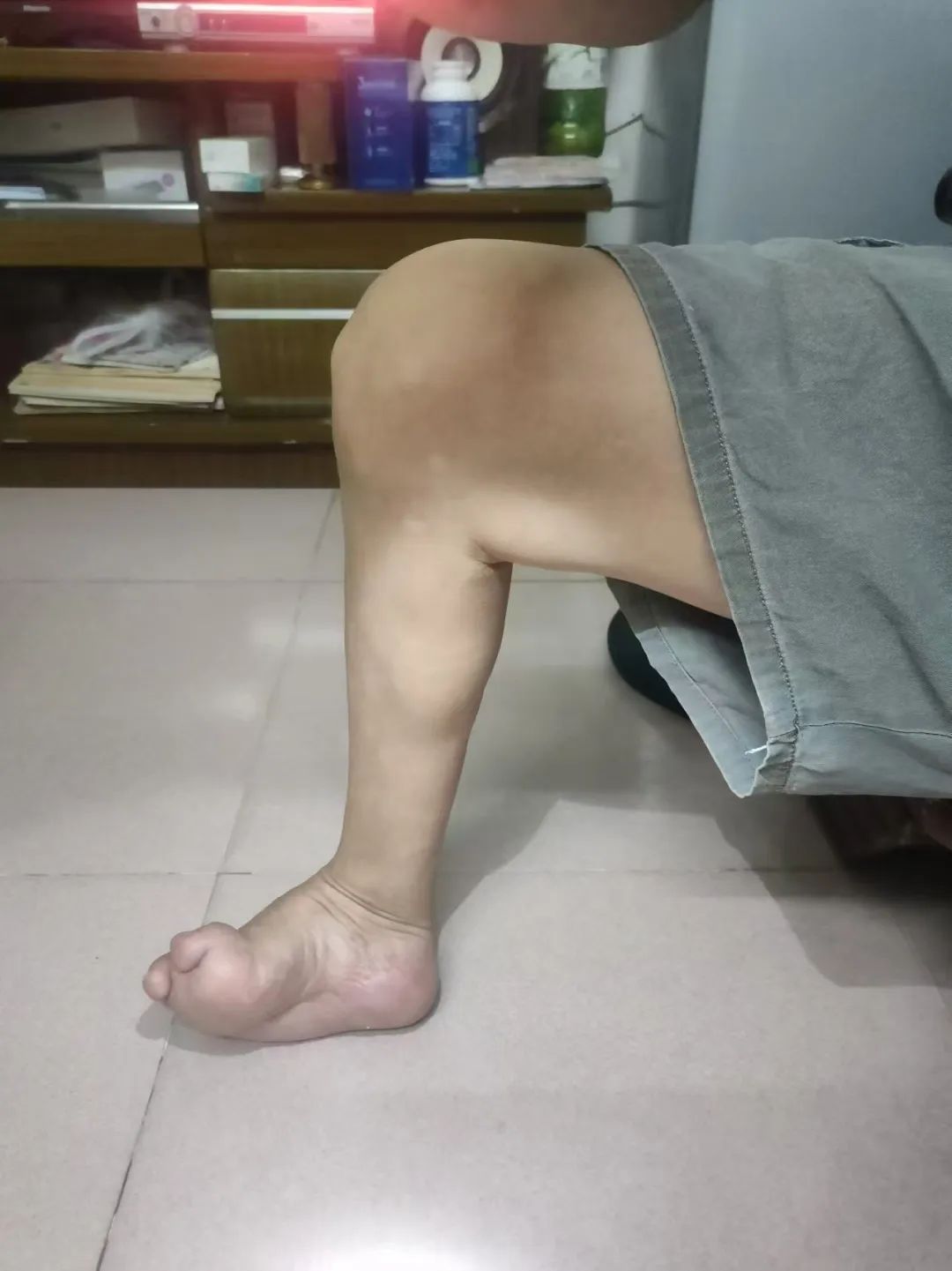 被马蹄内翻足「纠缠」55 年！漳州市第三医院助其稳健迈步