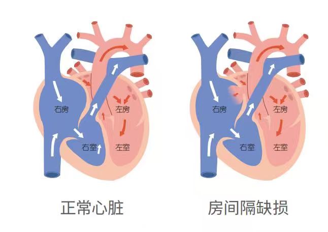 重庆松山医院成功开展生物可降解房间隔缺损封堵术