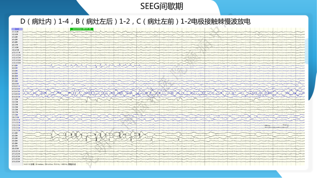 「痫停」信步》癫痫治疗病例荟萃第二十六期---SEEG 引导下射频热凝毁损治疗下丘脑错构瘤所致发笑癫痫
