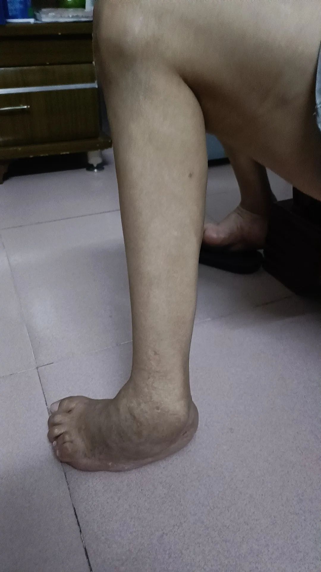 被马蹄内翻足「纠缠」55 年！漳州市第三医院助其稳健迈步