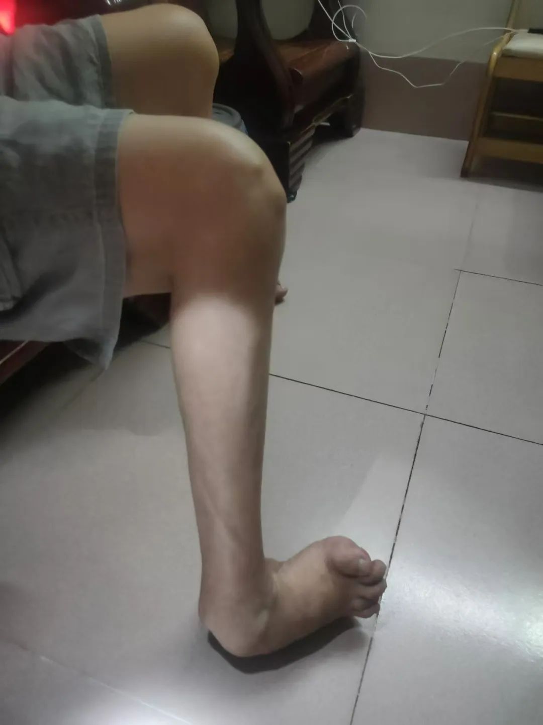 被马蹄内翻足「纠缠」55 年！漳州市第三医院助其稳健迈步