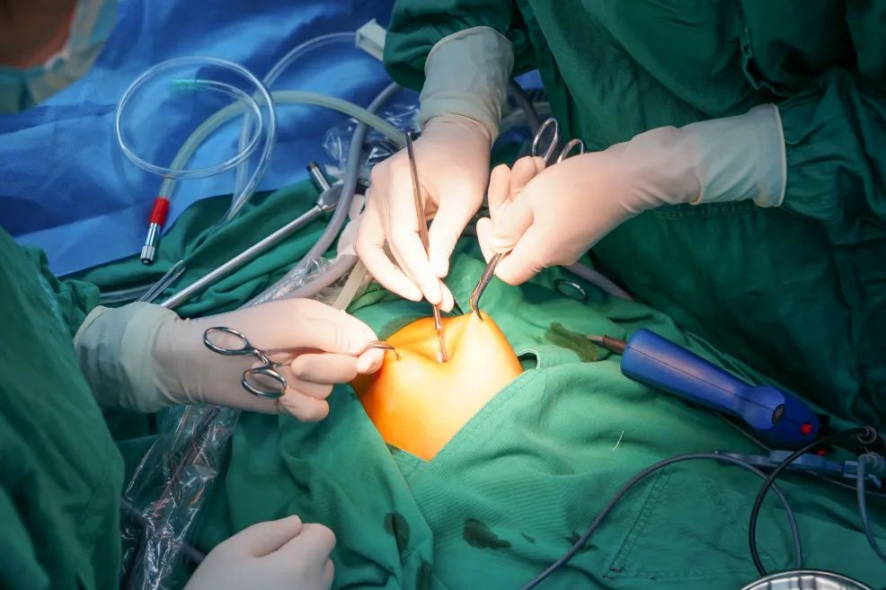 长沙江湾妇产医院技术院长周静在《妇科微型切口单孔腹腔镜手术理念与实践》上发表《微型切口单孔腹腔镜盆腔粘连松解术概述》,