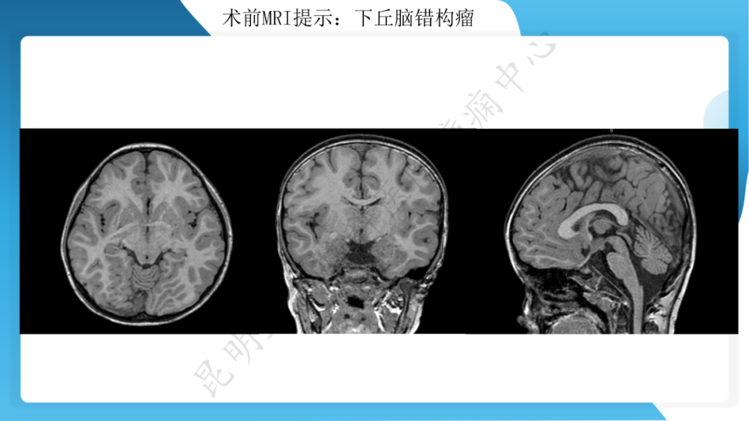 「痫停」信步》癫痫治疗病例荟萃第二十六期---SEEG 引导下射频热凝毁损治疗下丘脑错构瘤所致发笑癫痫