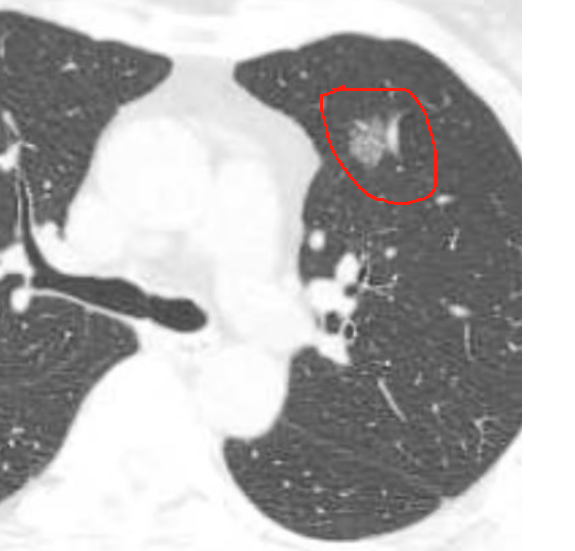 桂医大二附院成功开展「极致微创」肺癌肺段切除手术