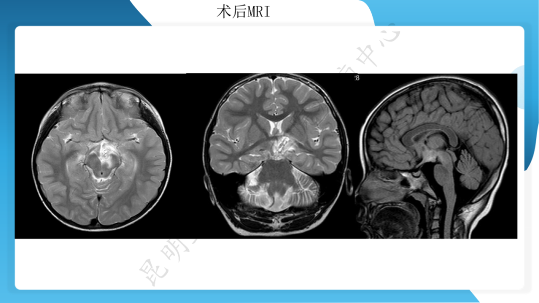 「痫停」信步》癫痫治疗病例荟萃第二十六期---SEEG 引导下射频热凝毁损治疗下丘脑错构瘤所致发笑癫痫