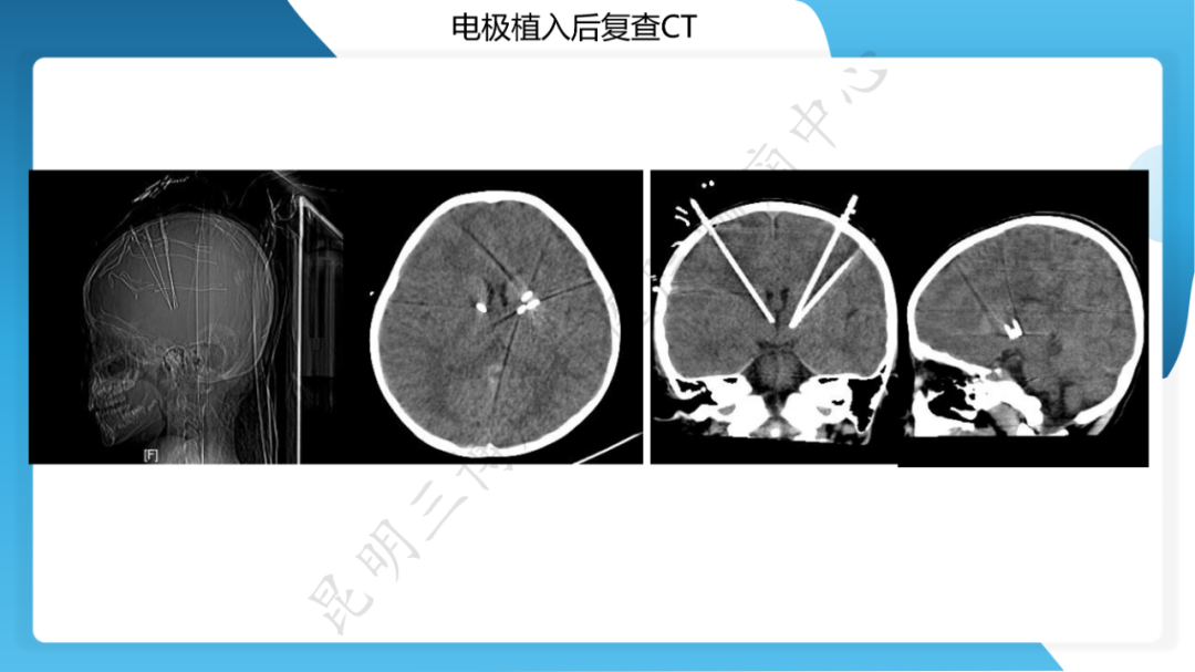 「痫停」信步》癫痫治疗病例荟萃第二十六期---SEEG 引导下射频热凝毁损治疗下丘脑错构瘤所致发笑癫痫
