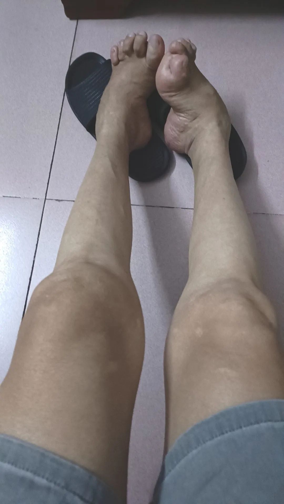 被马蹄内翻足「纠缠」55 年！漳州市第三医院助其稳健迈步