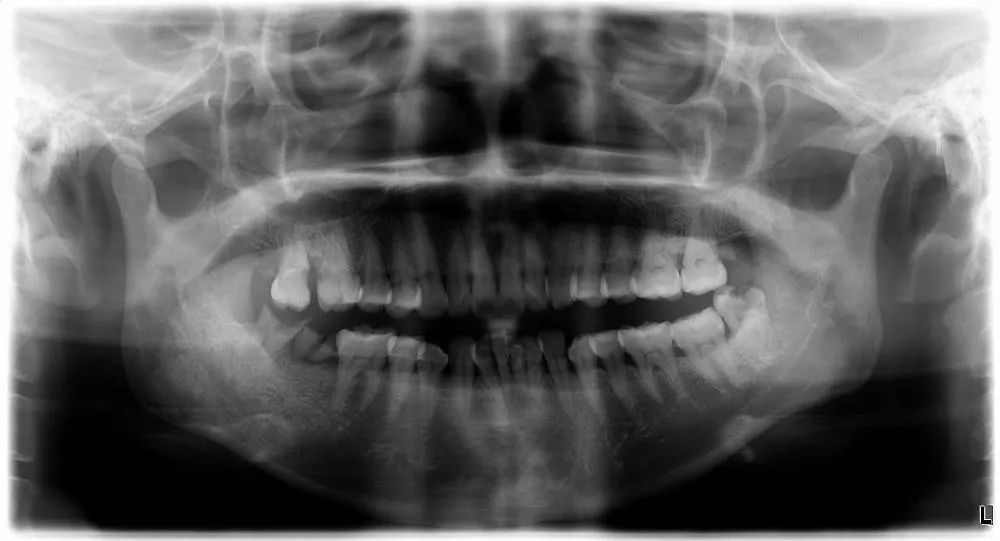 口腔 X 光拍片知多少?