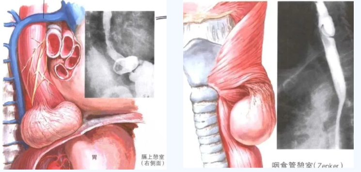 解密食管憩室，微创术克顽疾——经内镜黏膜下隧道憩室间脊切开术（STESD）