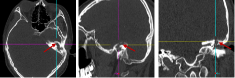 13 岁少年耳疾引发颅内感染——专家提醒:莫把「耳流脓」当小事!