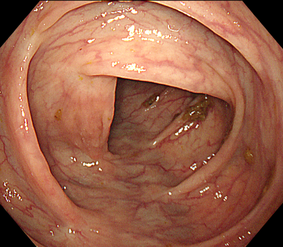 非洲 10 岁女孩被克罗恩病缠身,在中国找到希望!2 次跨国求医经历让父女想定居中国