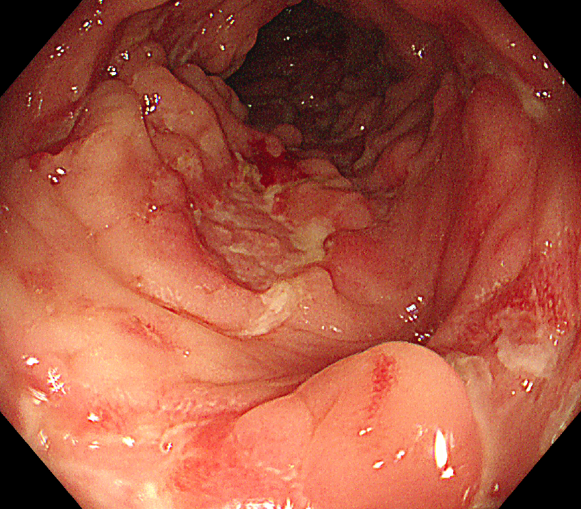 非洲 10 岁女孩被克罗恩病缠身,在中国找到希望!2 次跨国求医经历让父女想定居中国