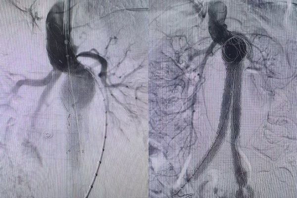 周末紧急救援：血管外科团队与 「腹主动脉瘤先兆破裂」 的生死竞速