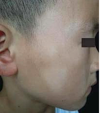 宝宝脸上长了「小白斑」？别慌，可能是单纯糠疹在「作祟」